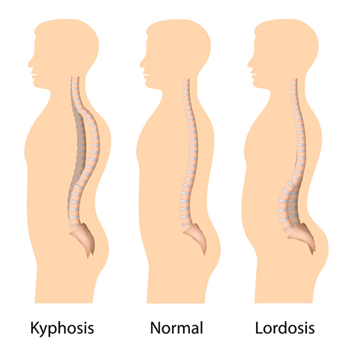 does-kyphosis-affect-height-2